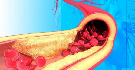 3 SIMPTOMA OTKRIVAJU DA LI IMATE ZAČEPLJENE ARTERIJE: Važno je uočiti na vrijeme! Evo kako vas tijelo upozorava