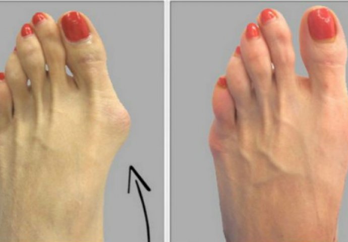 ŽULJAJU VAS I SMETAJU: Pogledajte kako se NAJLAKŠE riješiti čukljeva na nogama i bolova u zglobovima!