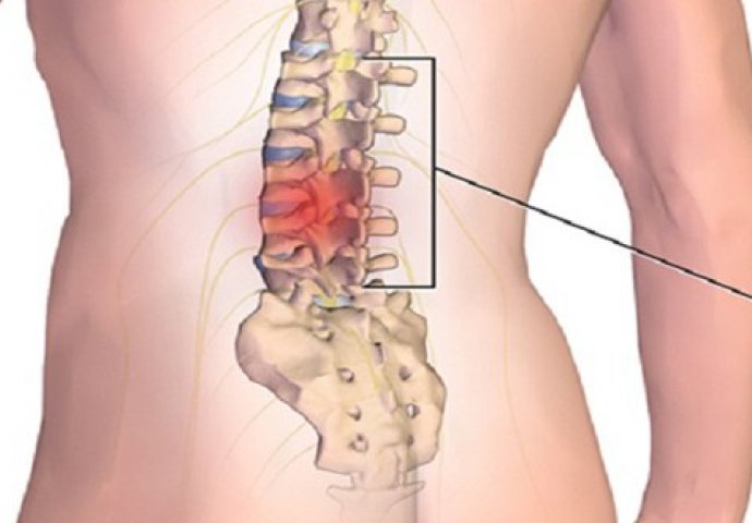 Prirodni lijek za kičmu: Postepeno uklanja bolove u leđima i nogama