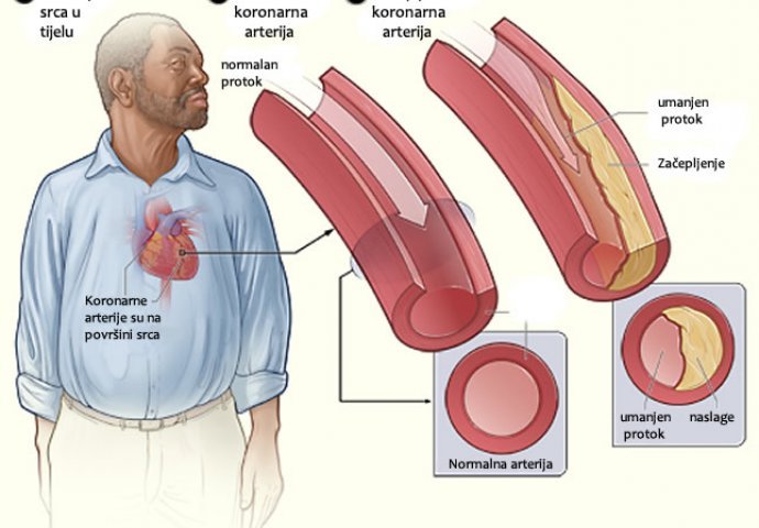 Ovo su simptomi da su vam vene i arterije začepljene: NE IGNORIŠITE IH!