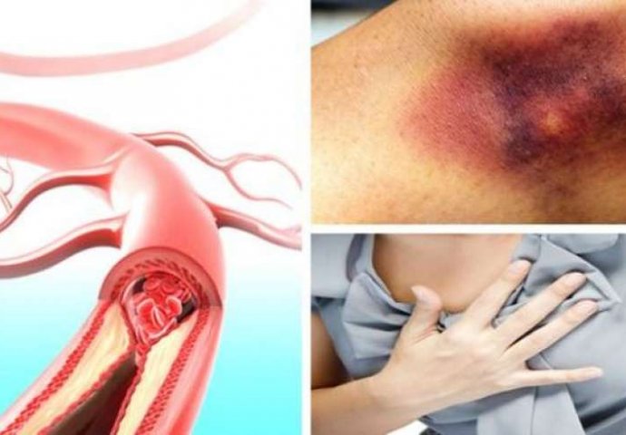 PREPOZNAJTE SIMPTOME TROMBA: Kada se krvni ugrušak nađe u blizini srca javljaju se sljedeći simptomi