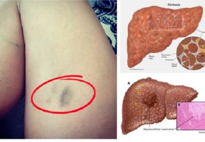Ovo su smrtonosni simptomi koji ukazuje da vam je jetra usporena i da će vas uskoro zakovati za krevet - PAŽLJIVO ČITAJTE!