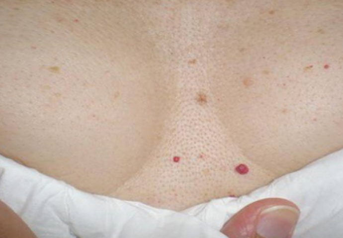 OVO SVI TREBAJU ZNATI: Ako imate ove crvene tačkice po tijelu, evo šta trebate raditi!