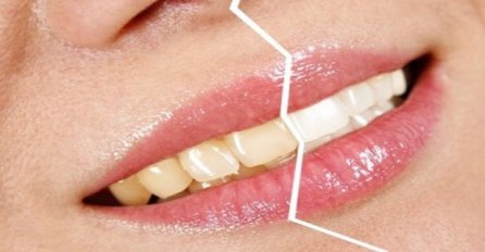 BEZ STOMATOLOGA I SKUPIH TRETMANA: Evo kako da i vaši zubi budu kao sa reklame!