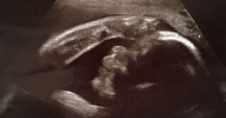DRAGA USPOMENA: Ovakve fotografije s ultrazvuka još niste vidjeli, jer ih nema baš svatko