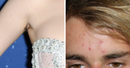 DLAKE ISPOD PAZUHA I UŽASNE BUBULJICE: Imaju MILIONE, a pojavili su se na crvenom tepihu u katastrofalnim izdanjima