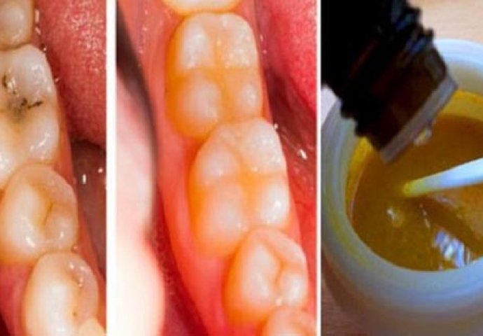 OVOM SMJESOM PERITE ZUBE I SPRIJEČITE KARIJES: Izbijelite ih bez odlaska zubaru