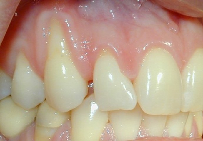 DJELUJTE DOK NIJE KASNO! Na vrijeme spriječite podmuklu bolest zbog koje možete ostati bez zubi!