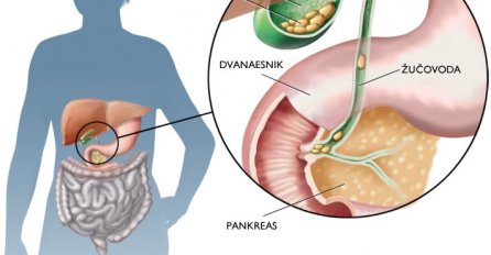 OVO SU SIMPTOMI KOJI UKAZUJU DA IMATE KAMEN U ŽUČI: Bol koja se teško podnosi!
