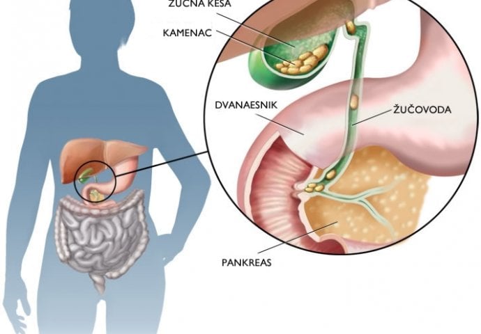 OVO SU SIMPTOMI KOJI UKAZUJU DA IMATE KAMEN U ŽUČI: Bol koja se teško podnosi!