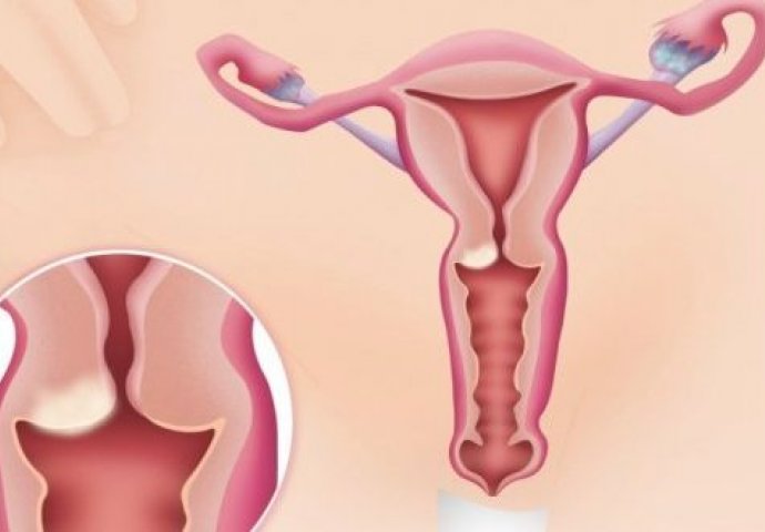 ČESTO GA IGNORIŠEMO: Samo 1 % žena može da prepozna ovaj uobičajan simptom raka jajnika 