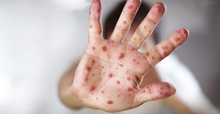 Novi slučajevi morbila u ZDK, neki učenici prešli na online nastavu