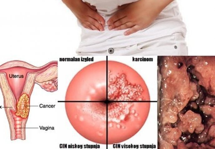 Ovo su prvi simptomi RAKA GRLIĆA MATERICE: Otkrijte ovu zlokobnu bolest na vrijeme!