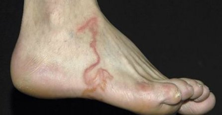 STRAŠNO: Mislio je da ima proširenu venu, nakon mjesec bolova, saznao je ŠOKANTNU ISTINU!