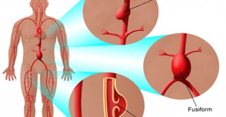 SPASITE SRCE, MOZAK I BUBREGE: Samo ova 3 sastojka potreba su da očistite vaše arterije!