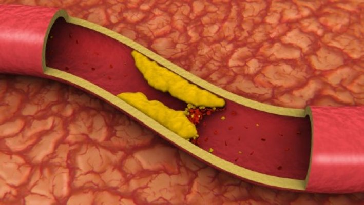 krvni-sud-holesterol