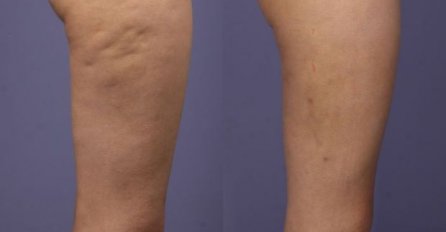 UKLANJA CELULIT I PODOČNJAKE, A ČUVA ZDRAVLJE: Namirnica koju ćete više cijeniti od sada