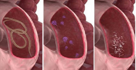 AKO IMATE OVE SIMPTOME, VAŠA CRIJEVA SU PUNA PARAZITA: Možete ih ukloniti JAKO BRZO sa ovom namirnicom 