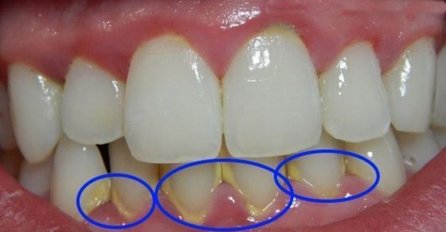 IMATE PLAK NA ZUBIMA? Evo kako da ga uklonite za 5 minuta!