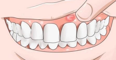 Zbog čega nastaju fistule na zubnom mesu? Evo šta vam tijelo pokušava reći