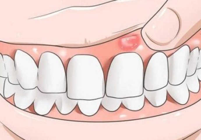 Zbog čega nastaju fistule na zubnom mesu? Evo šta vam tijelo pokušava reći