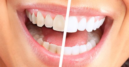 Evo kako da na prirodan način izbjelite zube: Ovo će vas raspametiti