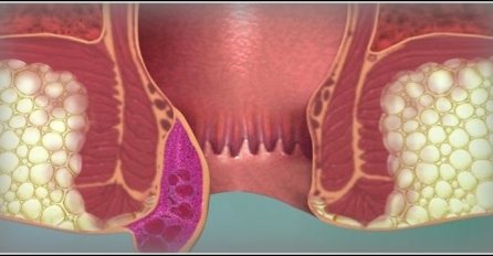 OVO SU GLAVNE RAZLIKE između HEMOROIDA I RAKA DEBELOG CRIJEVA: Ljekari su precizno izdvojili SIMPTOME koji uopšte nisu BEZAZLENI!