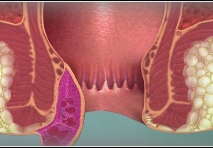 OVO SU GLAVNE RAZLIKE između HEMOROIDA I RAKA DEBELOG CRIJEVA: Ljekari su precizno izdvojili SIMPTOME koji uopšte nisu BEZAZLENI!