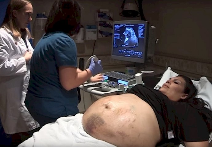 Njezin trudnički stomak je bio prekriven modricama: Ultrazvuk je otkrio zapanjujuću istinu!