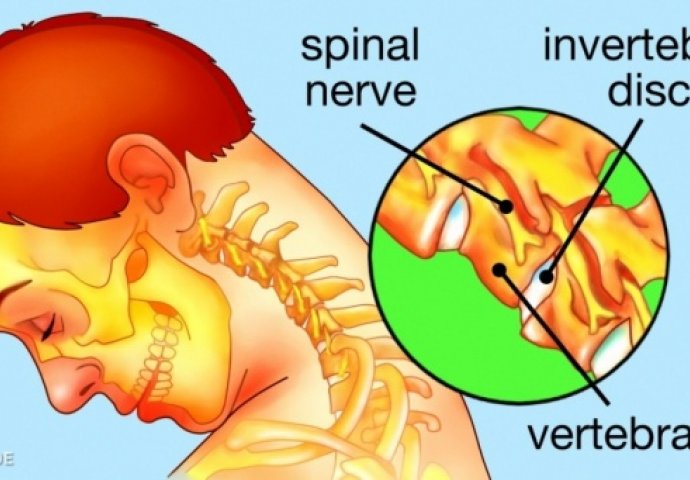 ZABORAVITE NA BOLOVE U VRATU: 9 načina koji vam mogu pomoći da se riješite bolova u vratu