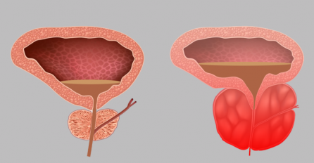PRVI SIMPTOMI RAKA PROSTATE, MUŠKARCI NE IGNORIŠITE: Ukoliko vam se OVO POJAVI, idite doktoru