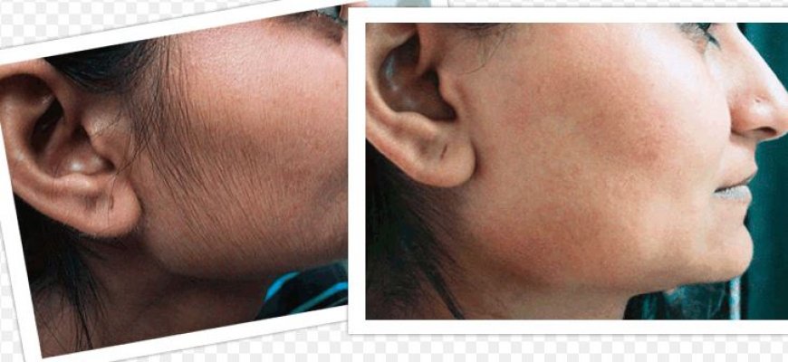 female-facial-hair-causes-menopause-aging-breakout-best-womens-moustache-removal
