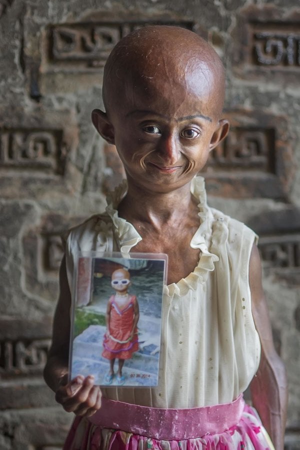 1-nitu-bravely-fighting-progeria-5adf76ca98f63-880