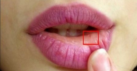 Ove promjene na usnama mogu ukazati na OZBILJAN PROBLEM, a evo i koji