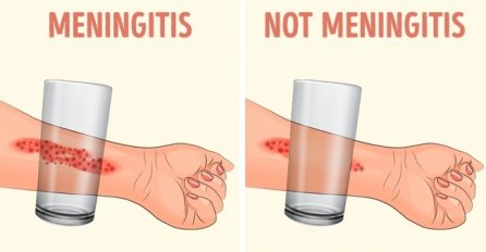 8 simptoma meningitisa koji bi svaki roditelj TREBAO ZNATI
