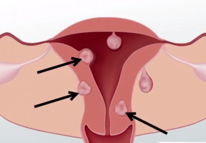 ŽENE OBRATITE PAŽNJU: Ovo su prvi simptomi MIOMA materice, obično ih je više, a ovi su NAJČEŠĆI 