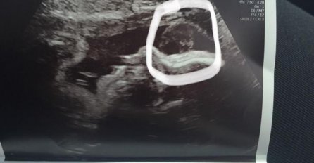 Dok je radio ultrazvuk doktor ju je pogledao i rekao NEŠTO ZBOG ČEGA JE GLUMICA BRISNULA U PLAČ