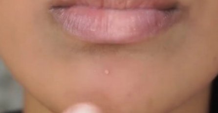 JAVLJAJU VAM SE BUBULJICE NA VRATU? UPOZORENJE LJEKARA: Evo šta vam se događa u organizmu!