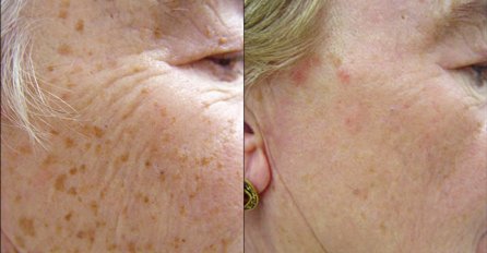 POZNATI DERMATOLOG TVRDI: Samo ovo stavite na lice i ZAUVIJEK SE RIJEŠITE smeđih mrlja sa lica i kože!