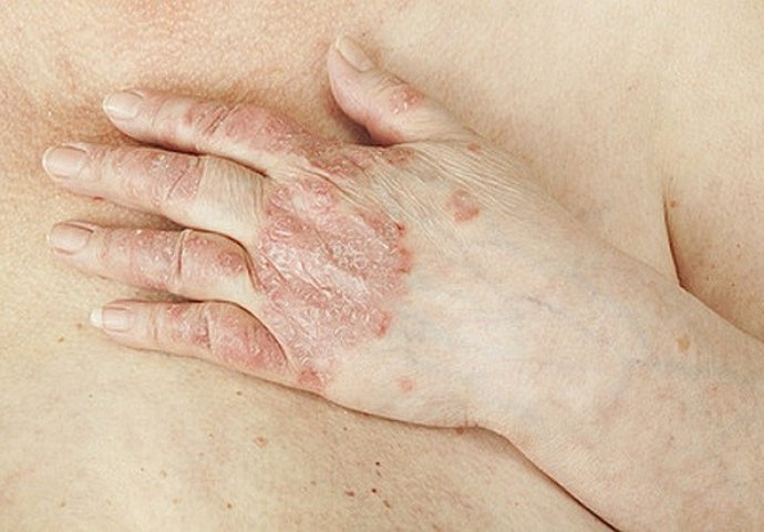 TRAVARI OTKRILI: Ovaj specijali eliksir liječi sve kožne bolesti UKLJUČUJUĆI I PSORIJAZU!