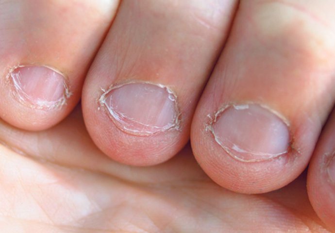 GRICKAO JE NOKTE, A ONDA MU JE PRST POČEO BUBRITI: Otac dvoje djece jedva ostao živ!