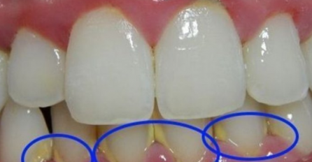 Nije skupa, možete je sami napraviti: Ona tečnost uklanja plak sa zuba za samo 2 minuta