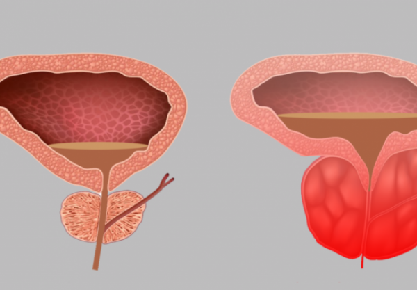 prostata2