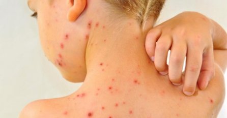 U Banjaluci dva nova slučaja morbila