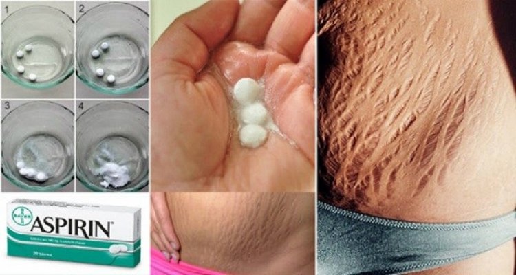 how-to-get-rid-of-stretch-marks-very-fast-by-using-aspirin-video