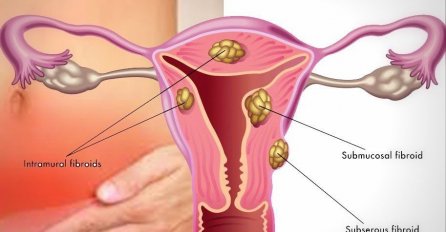 MIOMI NA MATERICI SVE VIŠE POGAĐAJU MLADE ŽENE, OVO SU SIMPTOMI: Obratite pažnju dok nije kasno