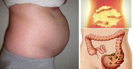 AKO OSJEĆATE OVE SIMPTOME, VAŠA CRIJEVA SU PUNA PARAZITA: Možete ih ukloniti brzo s ovom namirnicom 
