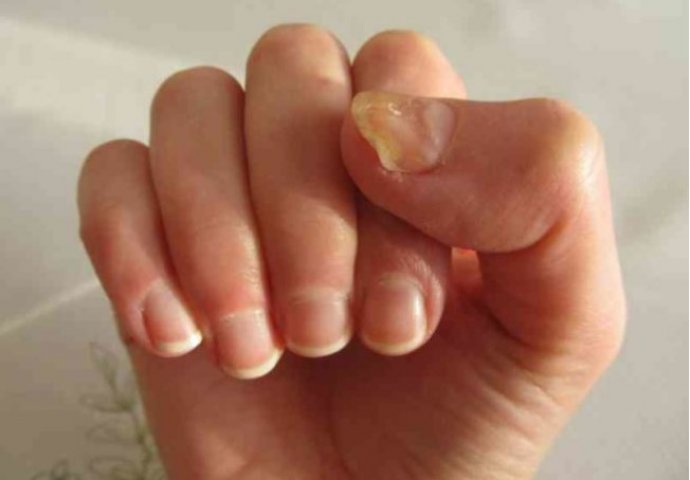 Naizgled bezopasni simptomi mogu ukazivati ​​na ove probleme: Evo šta vaši nokti govore o zdravlju