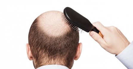 Ćelavost je problem s kojim se i muškarci i žene teško nose: Ovo su prirodna rješenja protiv opadanja kose