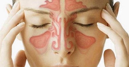 OVO JE NAJMOĆNIJI LIJEK ZA SINUSE! PRAVI SE OD SAMO 2 SASTOJKA: Evo šta trebate uraditi navečer prije spavanja! SVE ĆE PROČISTITI